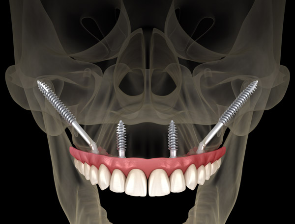A 3D Rendering of zygomatic dental implants