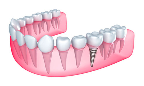 How Many Teeth do I Need to be Missing to Get Dental Implants?
