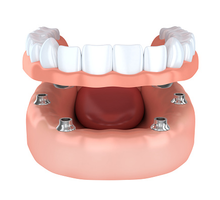 Diagram of implant supported denture
