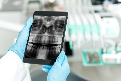 Digital x-ray from Placentia Oral Surgery on a tablet screen in Placentia, CA