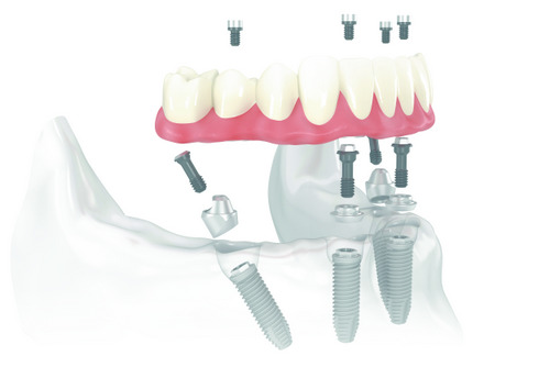 Diagram of All-on-4 Treatment Concept available at Placentia Oral Surgery
