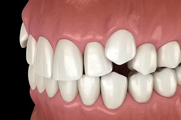 A 3d rendering of a mouth with impacted canine teeth