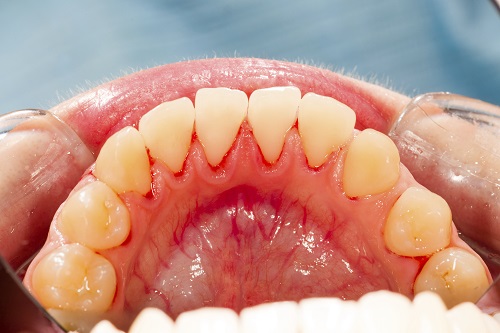 Does Gum Disease Harm False Teeth?