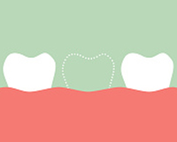 Illustration of teeth with a space of extracted tooth between two teeth at Placentia Oral Surgery.